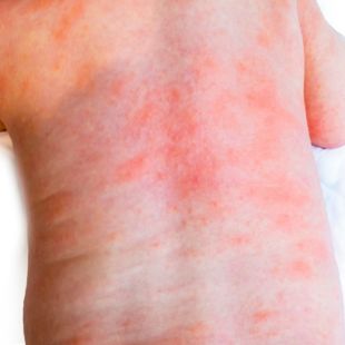 Melegkiütés kisgyermeknél, babánál: kialakulás, kezelés, megelőzés